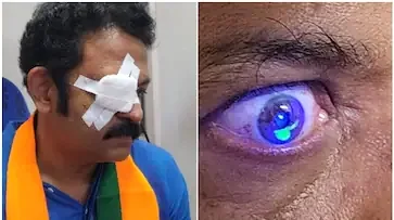 എൻഡിഎ സ്ഥാനാർഥി കൃഷ്ണ കുമാറിന് പ്രചരണത്തിനിടെ പരിക്ക്